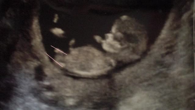 ultrasound 8 weeks. ultrasound 8 weeks: hb 163