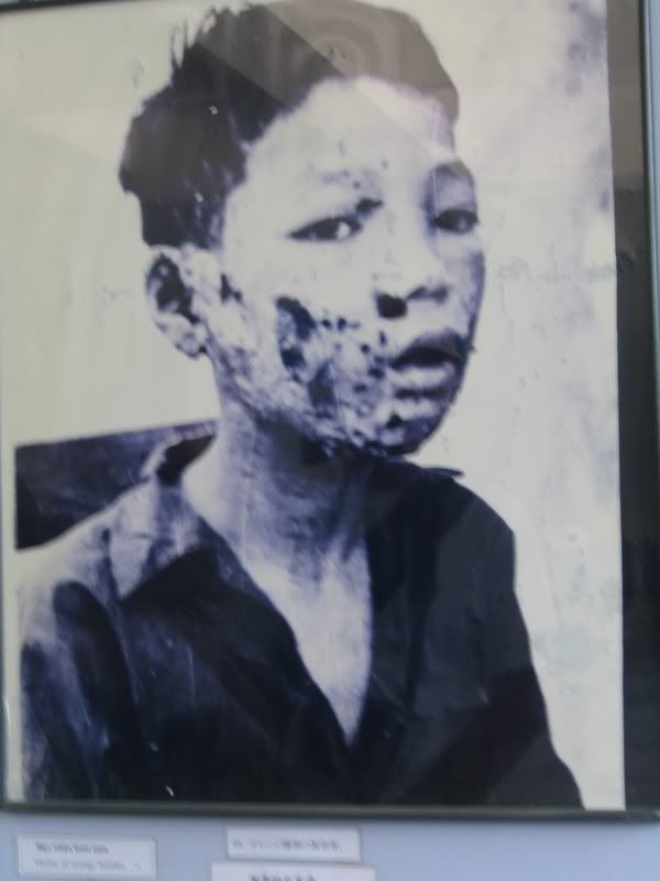 boy affected by orange bomb